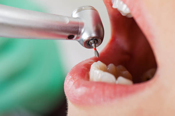Best Emergency Dental Extractions in Candlewick Lake, IL
